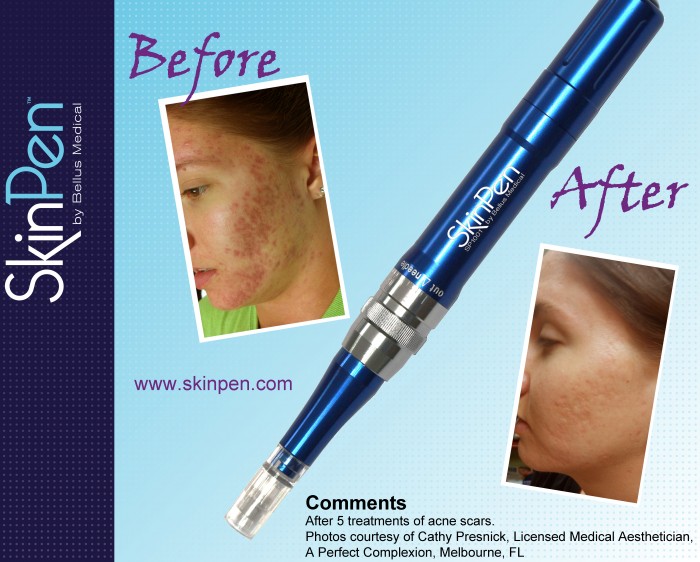 Bellus Medical Skinpen