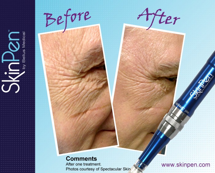 Bellus Medical Skinpen